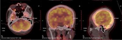 Malignant Eccrine <mark class="highlighted">Spiradenoma</mark> of the External Auditory Canal: A Case Report and Literature Review
